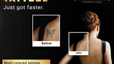 tattoo removal auckland